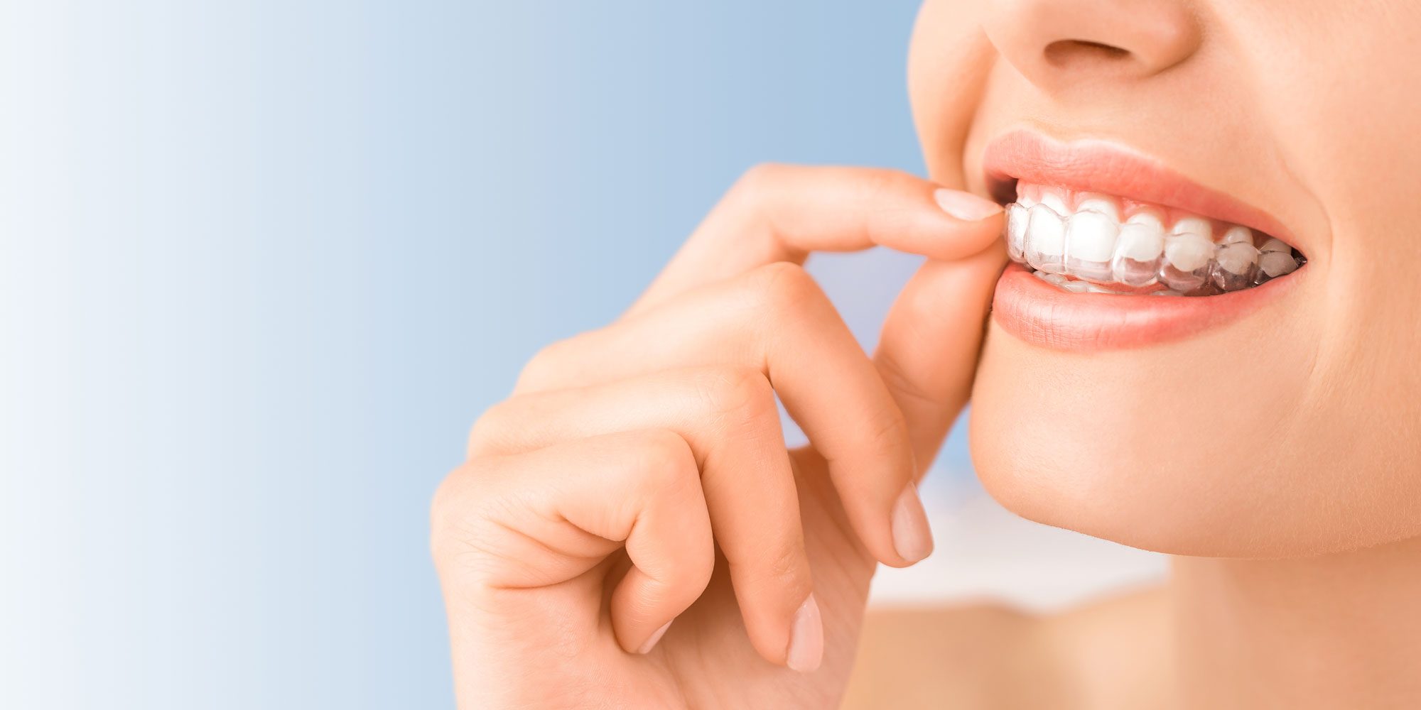Need To Change Invisalign Doctors? Here’s How