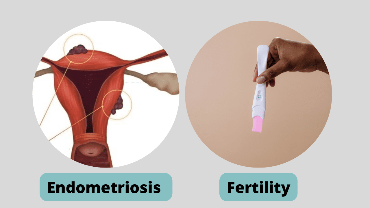 Endometriosis and ivf